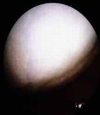 Distal Femur After Arthroplasty Distal Femur After Arthroplasty